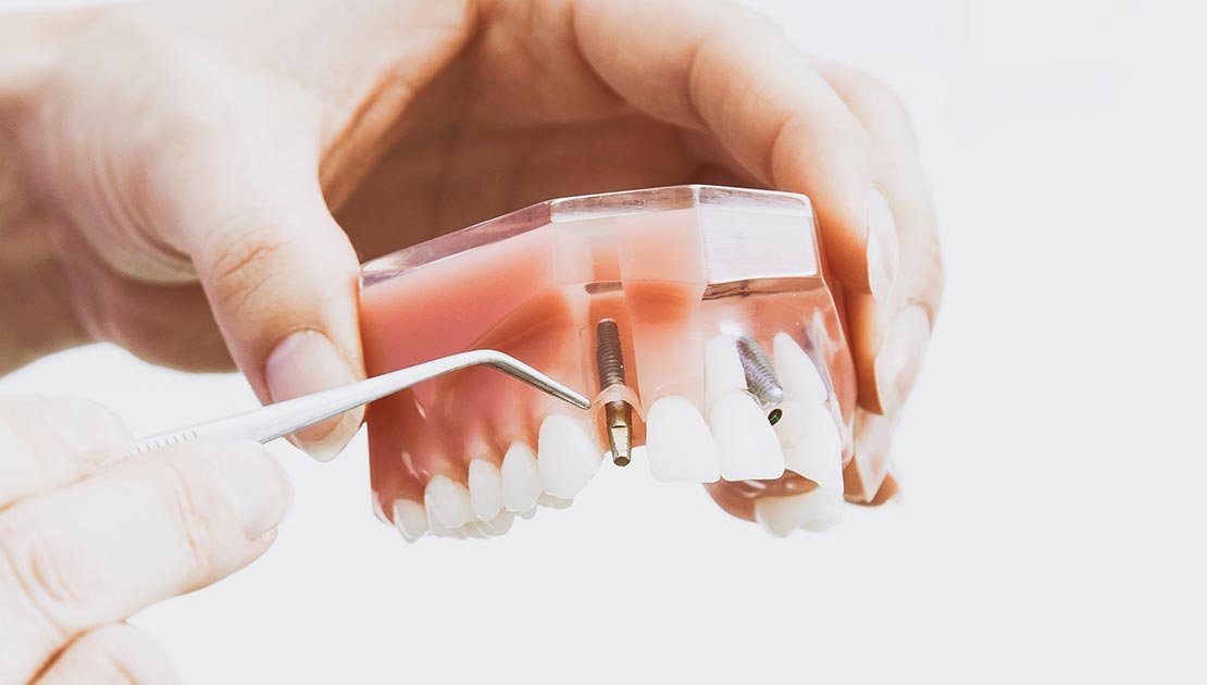 Person Demonstrating Dental Implants